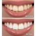 2 x 10cc / ml PEARLESCENCE CP 44% MINT Teeth Whitening System Photo Initiated